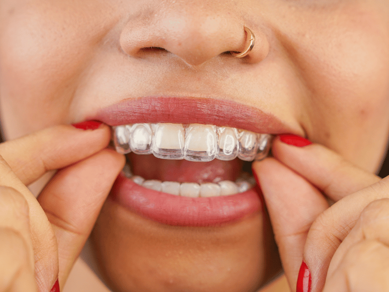 The Invisalign Process